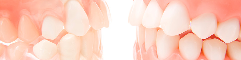 噛み合わせの悩み